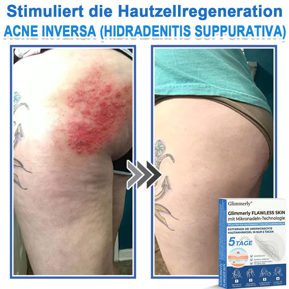 👩‍⚕️ Glimmerly® 2-in-1 Mikronadel- & Hydrokolloid-Pflaster ❄️ Entferner für erhabene Muttermale, Akne, flache Warzen & Hautanhängsel | Verbessert Falten, Narben & Hautunreinheiten | Unsichtbare Stern-Pickelpflaster für Gesicht & Körper