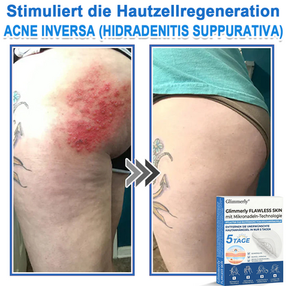 👩‍⚕️ Glimmerly® 2-in-1 Mikronadel- & Hydrokolloid-Pflaster ❄️ Entferner für erhabene Muttermale, Akne, flache Warzen & Hautanhängsel | Verbessert Falten, Narben & Hautunreinheiten | Unsichtbare Stern-Pickelpflaster für Gesicht & Körper