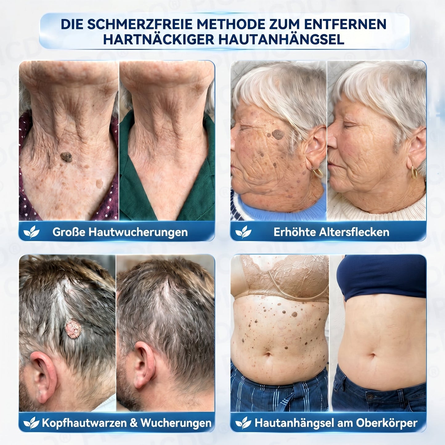 𝐏𝐢𝐜𝐝𝐨® 🥇 𝟕-𝐓𝐚𝐠𝐞 𝐇𝐚𝐮𝐭𝐚𝐧𝐡ä𝐧𝐠𝐬𝐞𝐥- & 𝐅𝐥𝐞𝐜𝐤𝐞𝐧-𝐄𝐧𝐭𝐟𝐞𝐫𝐧𝐮𝐧𝐠𝐬𝐜𝐫𝐞𝐦𝐞 (𝐒𝐜𝐡𝐦𝐞𝐫𝐳𝐟𝐫𝐞𝐢𝐞 𝐅𝐨𝐫𝐦𝐞𝐥 – 𝐨𝐡𝐧𝐞 𝐍𝐚𝐫𝐛𝐞𝐧)🔥