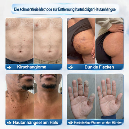 Offizieller Markenstore |🍟𝑷𝑖𝒄𝐝𝐨® 7-𝑻𝒂𝒈𝒆 𝑯𝒂𝒖𝒕𝒂𝒏𝒉ä𝒏𝒈𝒔𝒆𝒍- & 𝑭𝒍𝒆𝒄𝒌𝒆𝒏𝒆𝒏𝒕𝒇𝒆𝒓𝒏𝒆𝒓(Schmerzfreier Rollerball – Keine Narbenbildung)🥙