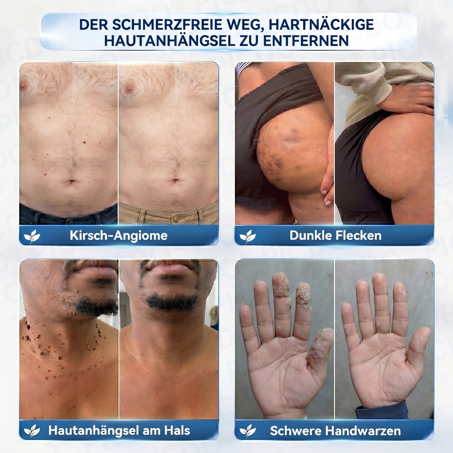 𝐏𝐢𝐜𝐝𝐨® 🥇 𝟕-𝐓𝐚𝐠𝐞 𝐇𝐚𝐮𝐭𝐚𝐧𝐡ä𝐧𝐠𝐬𝐞𝐥- & 𝐅𝐥𝐞𝐜𝐤𝐞𝐧-𝐄𝐧𝐭𝐟𝐞𝐫𝐧𝐮𝐧𝐠𝐬𝐜𝐫𝐞𝐦𝐞 (𝐒𝐜𝐡𝐦𝐞𝐫𝐳𝐟𝐫𝐞𝐢𝐞 𝐅𝐨𝐫𝐦𝐞𝐥 – 𝐨𝐡𝐧𝐞 𝐍𝐚𝐫𝐛𝐞𝐧)🔥