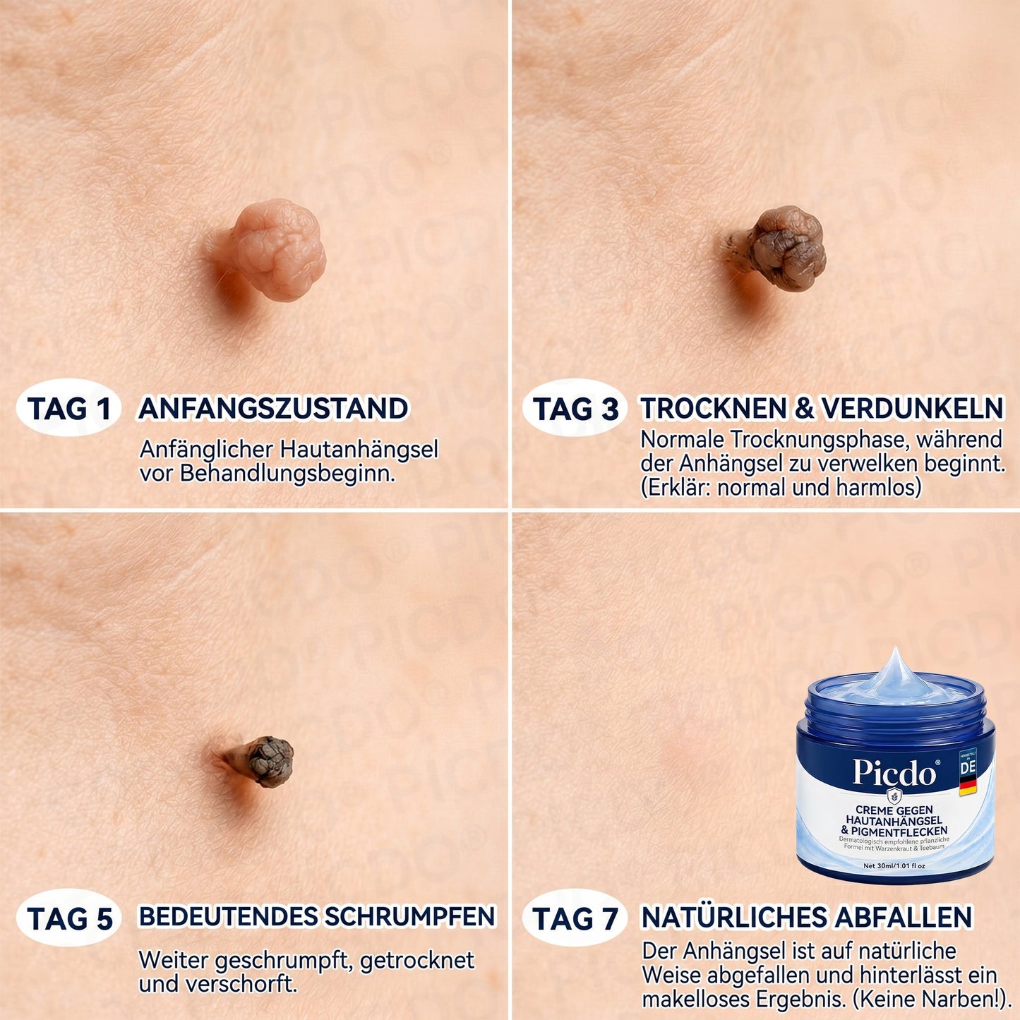 𝐏𝐢𝐜𝐝𝐨® 🥇 𝟕-𝐓𝐚𝐠𝐞 𝐇𝐚𝐮𝐭𝐚𝐧𝐡ä𝐧𝐠𝐬𝐞𝐥- & 𝐅𝐥𝐞𝐜𝐤𝐞𝐧-𝐄𝐧𝐭𝐟𝐞𝐫𝐧𝐮𝐧𝐠𝐬𝐜𝐫𝐞𝐦𝐞 (𝐒𝐜𝐡𝐦𝐞𝐫𝐳𝐟𝐫𝐞𝐢𝐞 𝐅𝐨𝐫𝐦𝐞𝐥 – 𝐨𝐡𝐧𝐞 𝐍𝐚𝐫𝐛𝐞𝐧)🔥