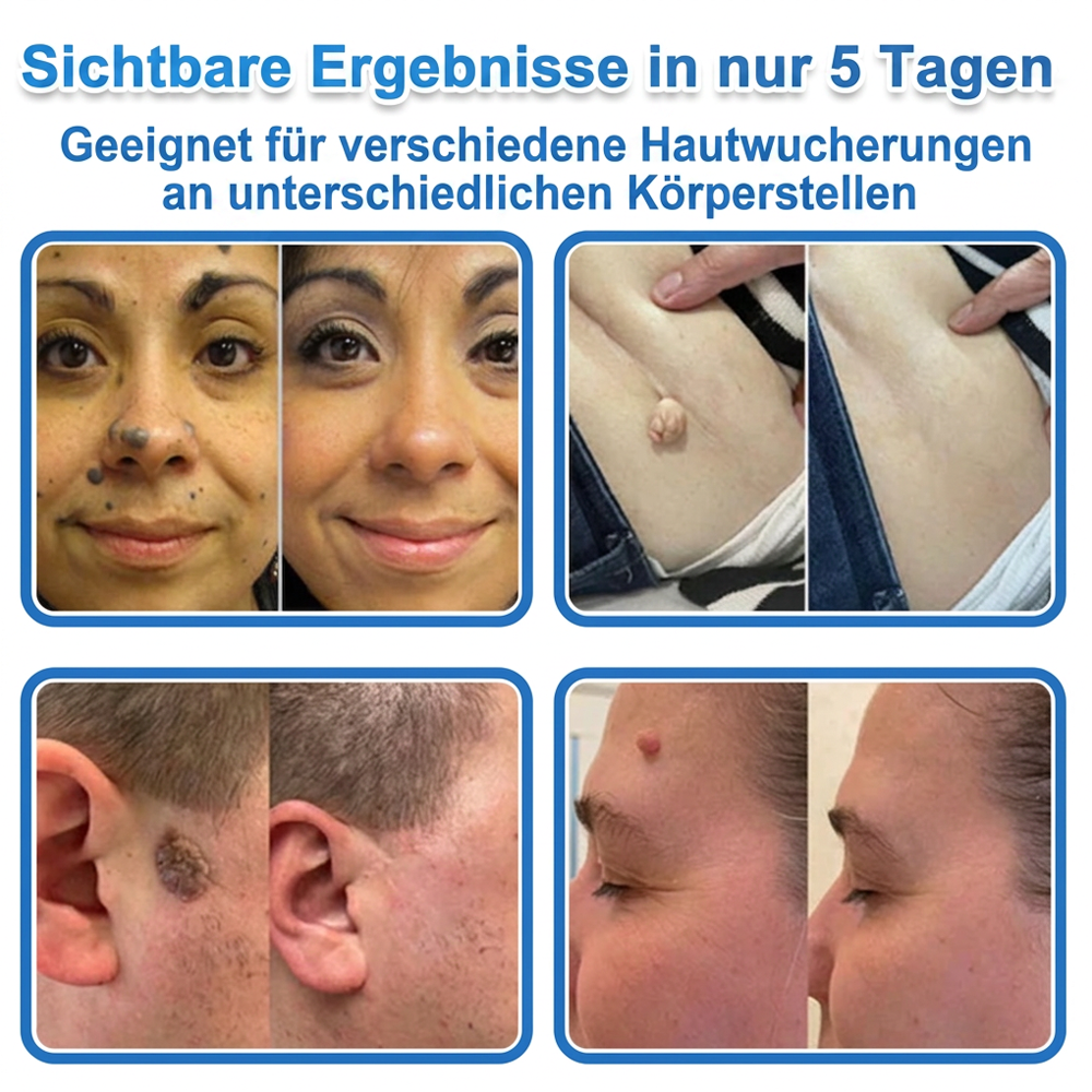 👩‍⚕️ Glimmerly® 2-in-1 Mikronadel- & Hydrokolloid-Pflaster ❄️ Entferner für erhabene Muttermale, Akne, flache Warzen & Hautanhängsel | Verbessert Falten, Narben & Hautunreinheiten | Unsichtbare Stern-Pickelpflaster für Gesicht & Körper