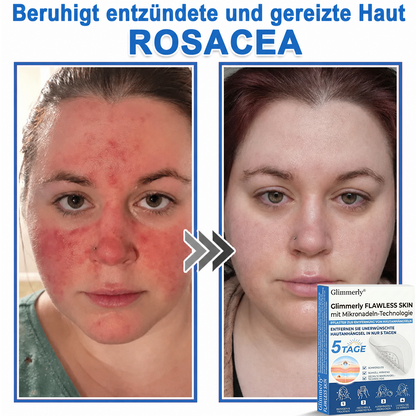 👩‍⚕️ Glimmerly® 2-in-1 Mikronadel- & Hydrokolloid-Pflaster ❄️ Entferner für erhabene Muttermale, Akne, flache Warzen & Hautanhängsel | Verbessert Falten, Narben & Hautunreinheiten | Unsichtbare Stern-Pickelpflaster für Gesicht & Körper