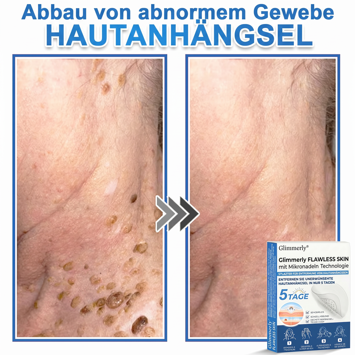 👩‍⚕️ Glimmerly® 2-in-1 Mikronadel- & Hydrokolloid-Pflaster ❄️ Entferner für erhabene Muttermale, Akne, flache Warzen & Hautanhängsel | Verbessert Falten, Narben & Hautunreinheiten | Unsichtbare Stern-Pickelpflaster für Gesicht & Körper